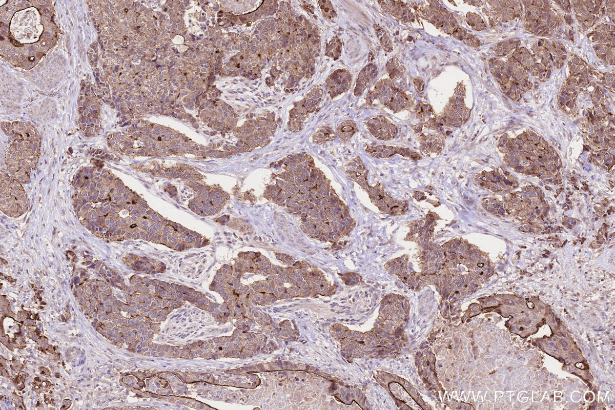 Immunohistochemistry (IHC) staining of human stomach cancer tissue using C19orf21 Polyclonal antibody (26338-1-AP)