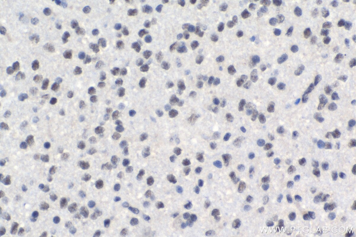 Immunohistochemistry (IHC) staining of human gliomas tissue using C19orf43 Polyclonal antibody (19420-1-AP)