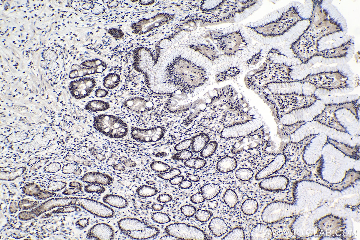 Immunohistochemistry (IHC) staining of human stomach cancer tissue using C19orf43 Polyclonal antibody (19420-1-AP)