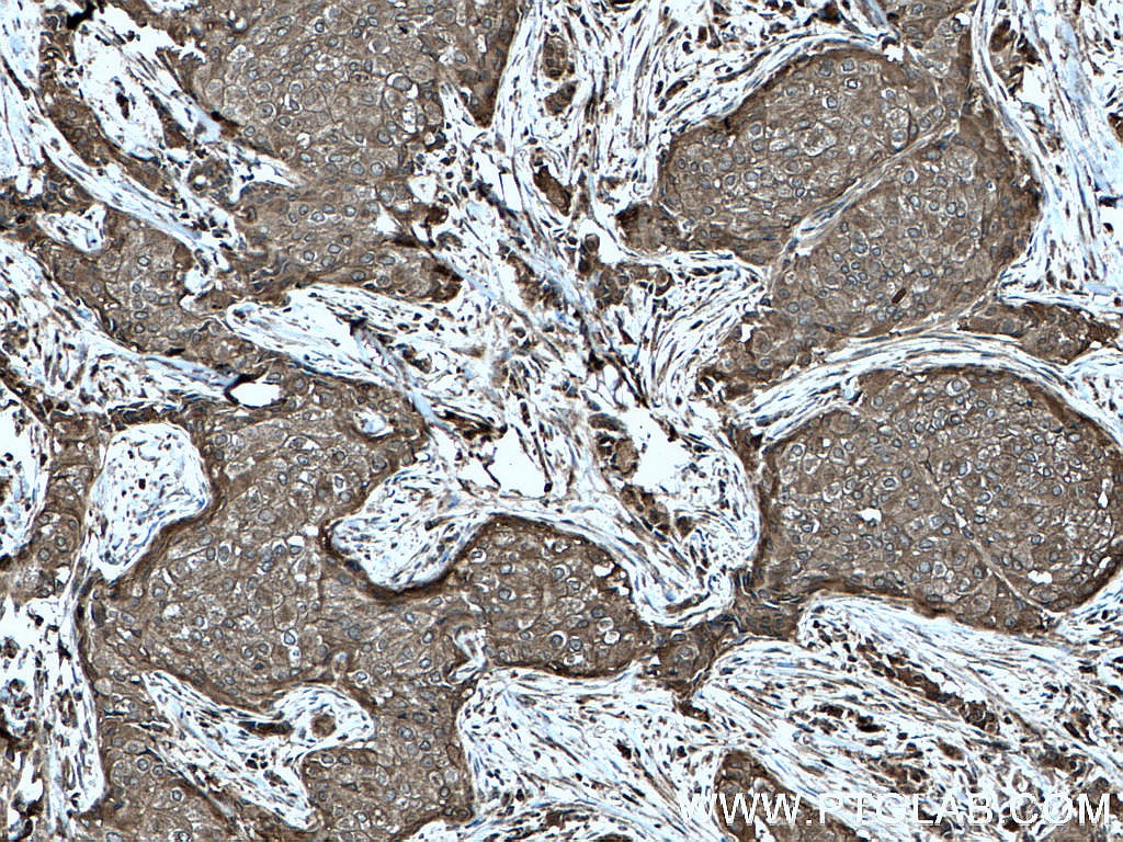 IHC staining of human breast cancer using 27926-1-AP