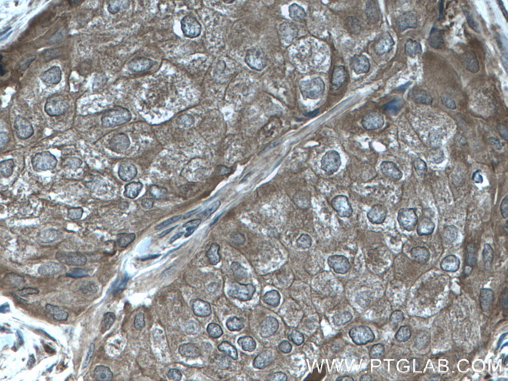 Immunohistochemistry (IHC) staining of human breast cancer tissue using C19orf62 Polyclonal antibody (27926-1-AP)