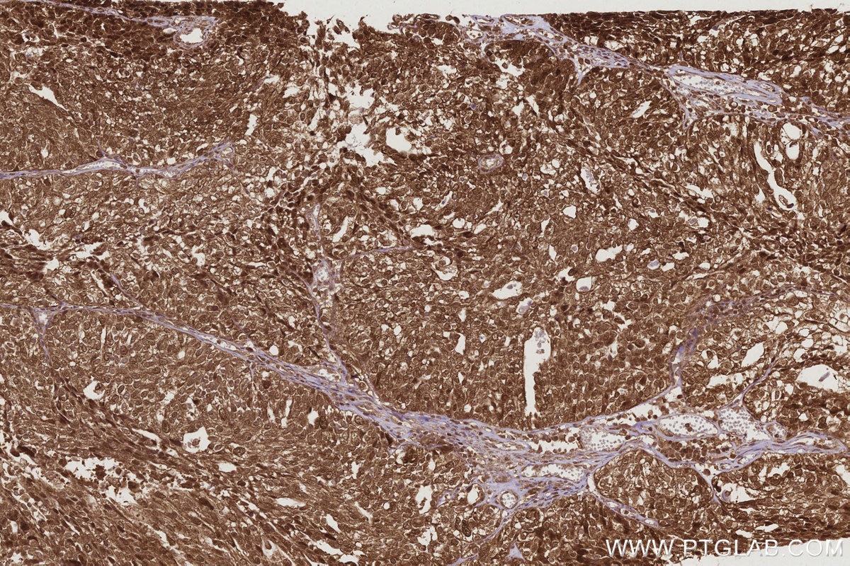 Immunohistochemistry (IHC) staining of human ovary cancer tissue using MERIT40 Polyclonal antibody (27926-1-AP)