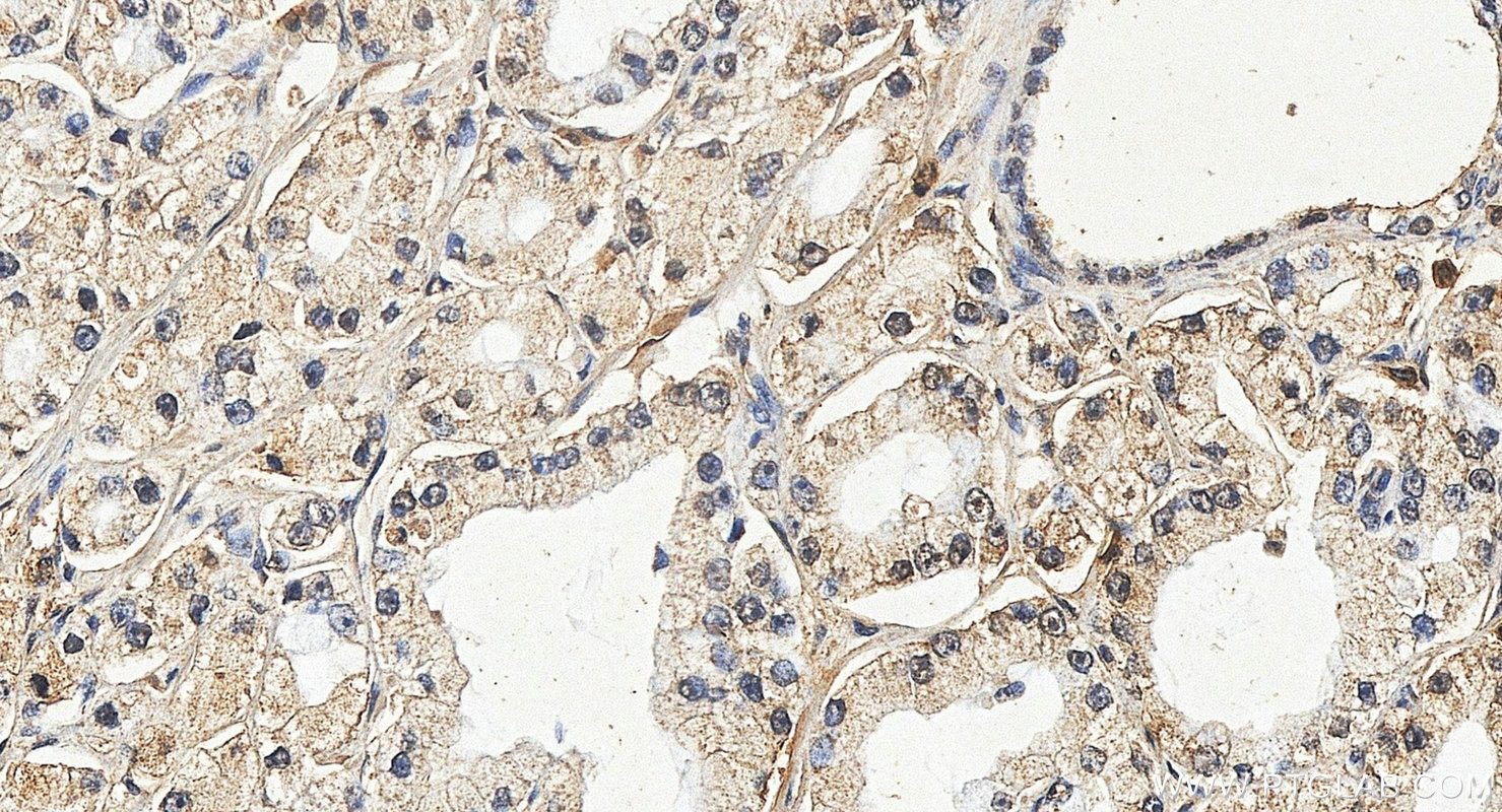 IHC staining of human prostate cancer using 24856-1-AP Immunohistochemistry (IHC) staining of human prostate cancer tissue using C19orf73 Polyclonal antibody (24856-1-AP)