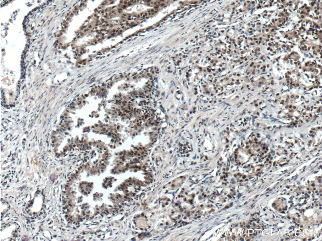 Immunohistochemistry (IHC) staining of human prostate cancer tissue using C1D Polyclonal antibody (10711-1-AP)