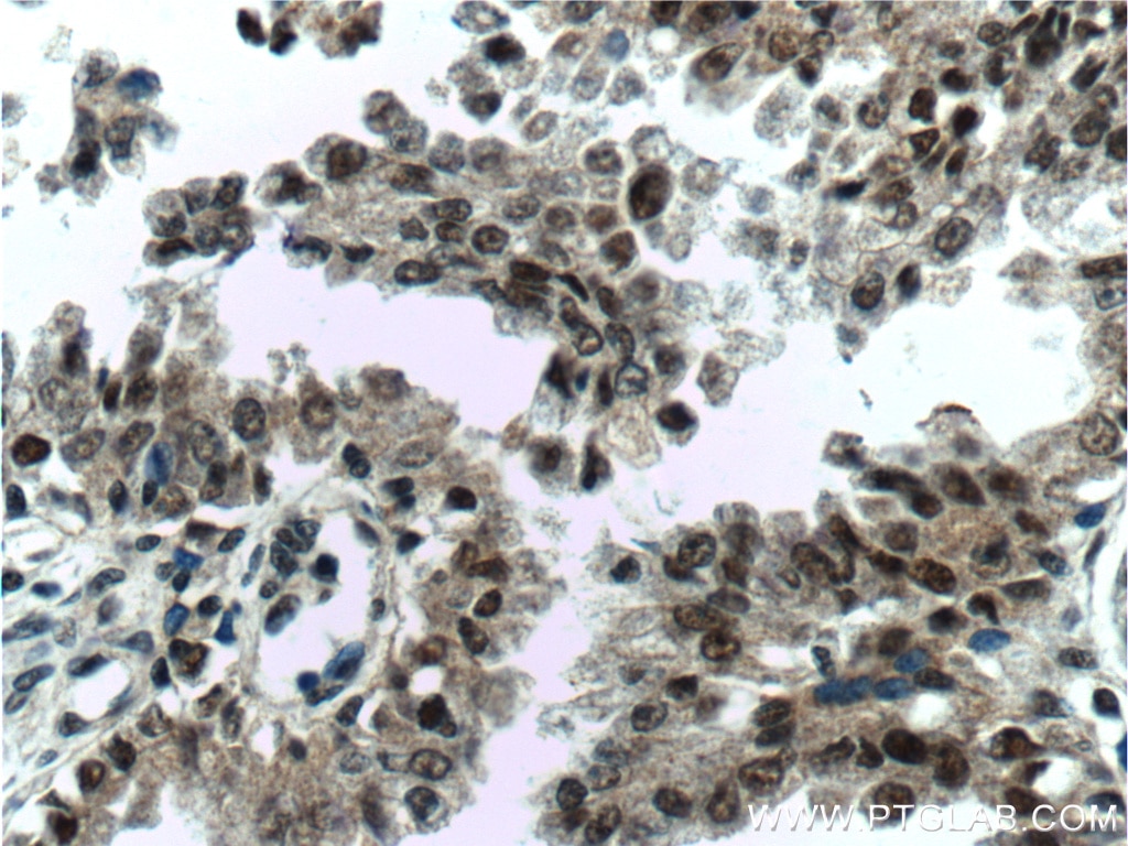 Immunohistochemistry (IHC) staining of human prostate cancer tissue using C1D Polyclonal antibody (10711-1-AP)