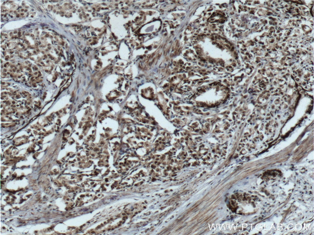 Immunohistochemistry (IHC) staining of human prostate cancer tissue using C1D Polyclonal antibody (10711-1-AP)