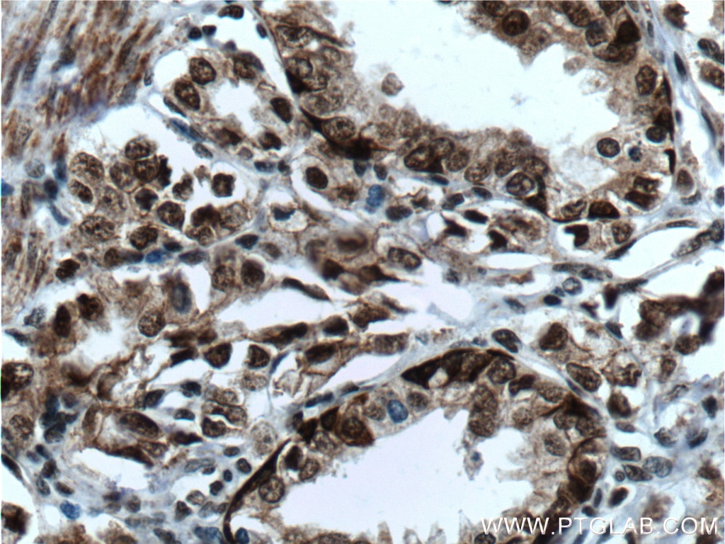 Immunohistochemistry (IHC) staining of human prostate cancer tissue using C1D Polyclonal antibody (10711-1-AP)