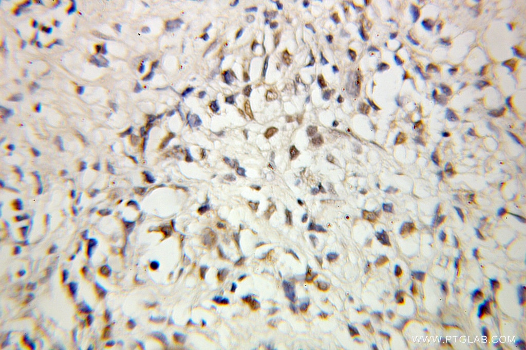 Immunohistochemistry (IHC) staining of human prostate cancer tissue using C1D Polyclonal antibody (10711-1-AP)