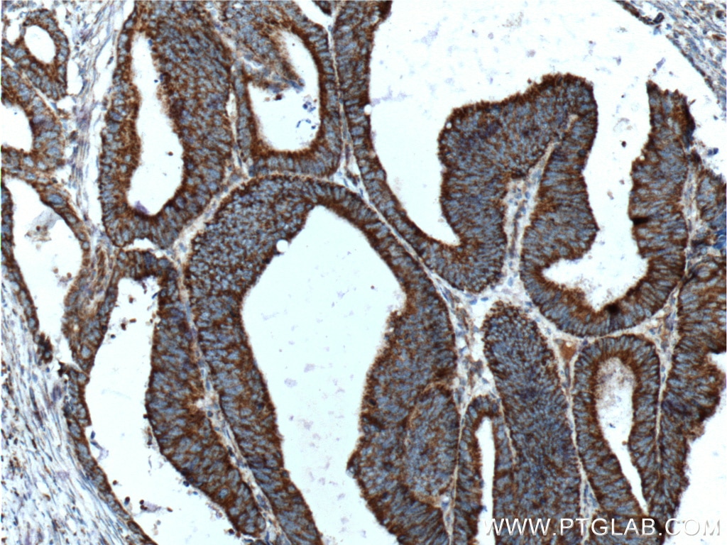 Immunohistochemistry (IHC) staining of human colon cancer tissue using COSMC Polyclonal antibody (19254-1-AP)