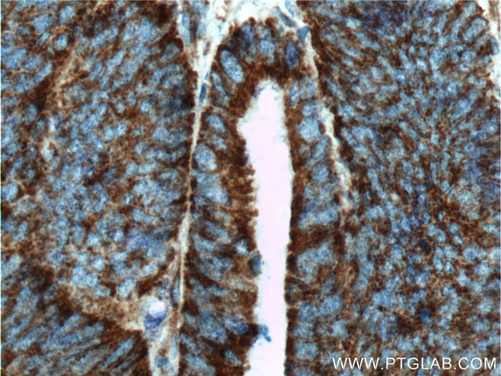 Immunohistochemistry (IHC) staining of human colon cancer tissue using COSMC Polyclonal antibody (19254-1-AP)