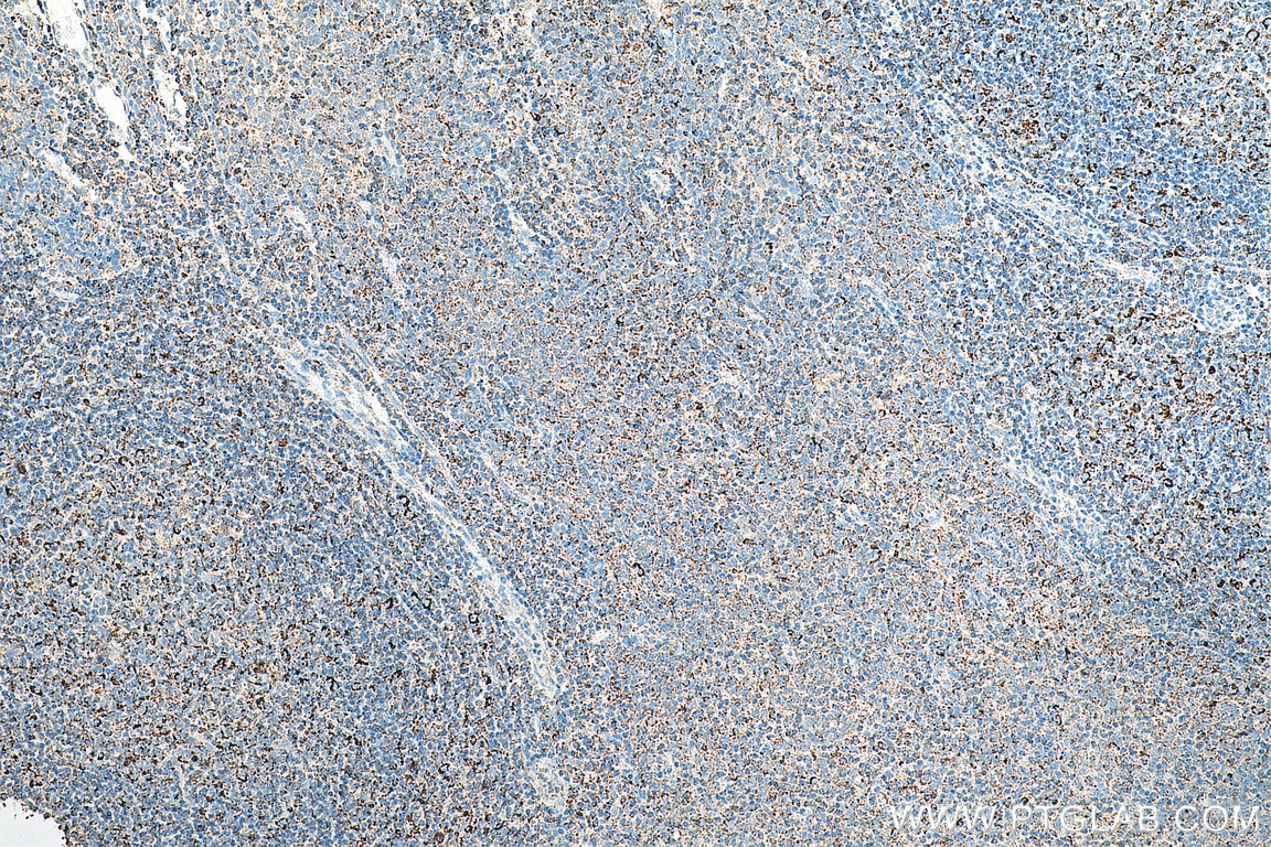 Immunohistochemistry (IHC) staining of human tonsillitis tissue using C1QBP Polyclonal antibody (24474-1-AP)