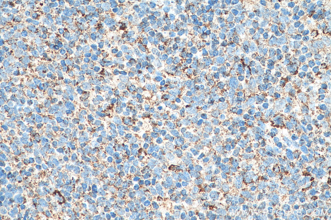 Immunohistochemistry (IHC) staining of human tonsillitis tissue using C1QBP Polyclonal antibody (24474-1-AP)
