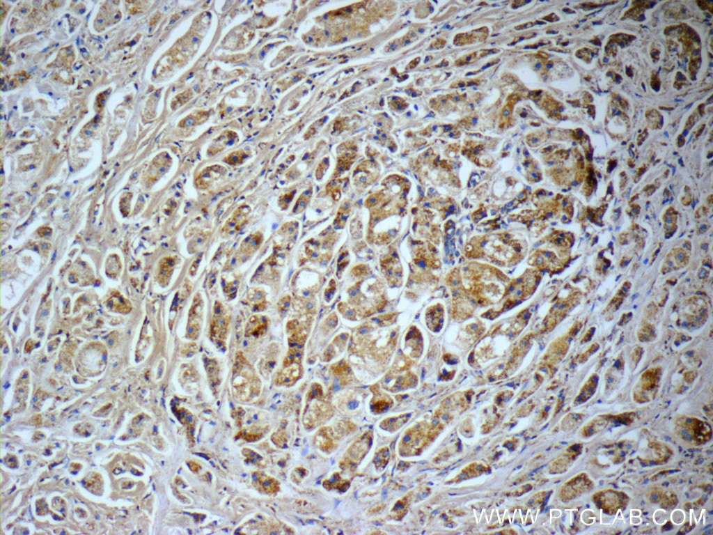 Immunohistochemistry (IHC) staining of human breast cancer tissue using C1QBP Polyclonal antibody (24474-1-AP)