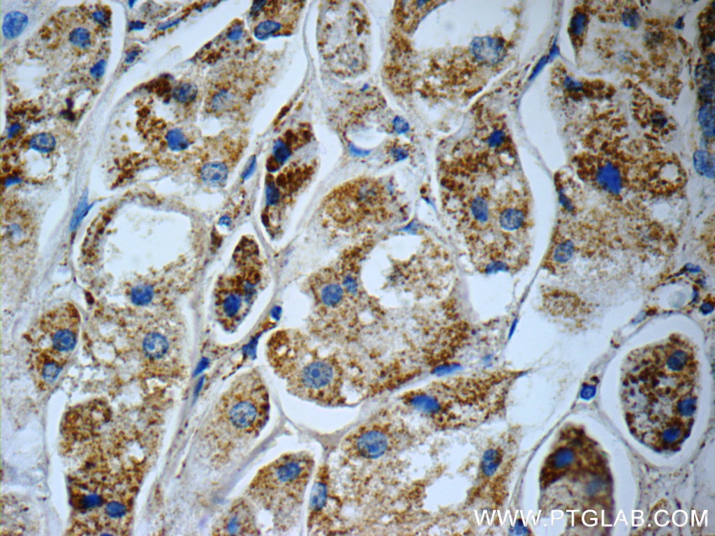 Immunohistochemistry (IHC) staining of human breast cancer tissue using C1QBP Polyclonal antibody (24474-1-AP)