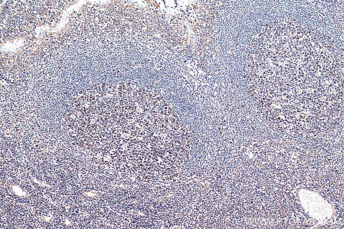 Immunohistochemistry (IHC) staining of human tonsillitis tissue using C1QBP Monoclonal antibody (68084-1-Ig)