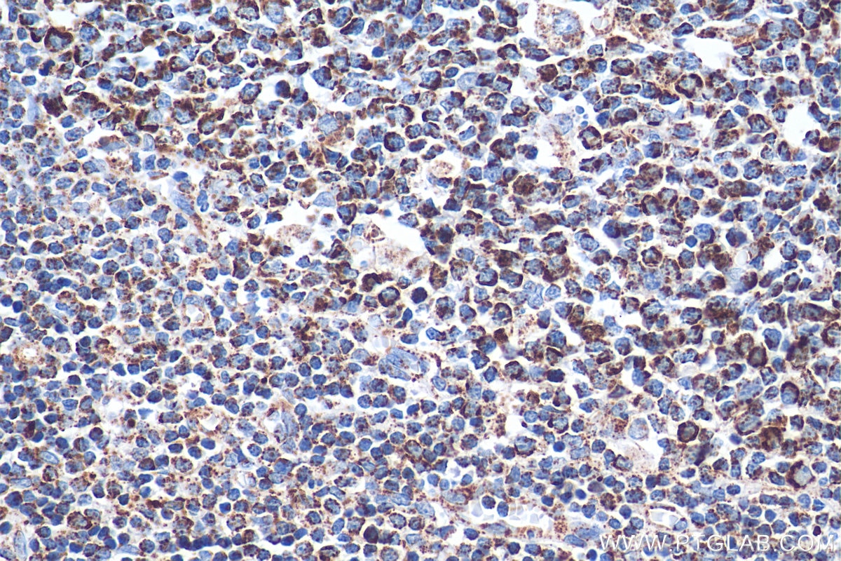 Immunohistochemistry (IHC) staining of human tonsillitis tissue using C1QBP Monoclonal antibody (68084-1-Ig)