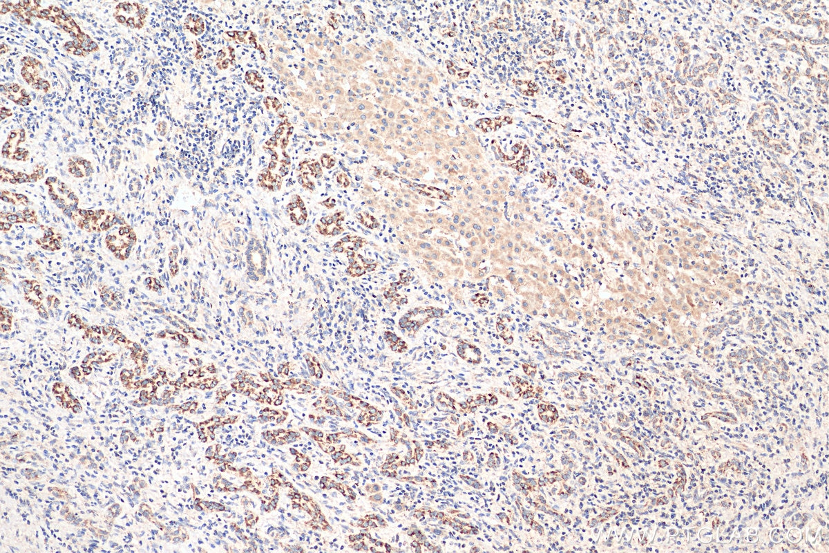 Immunohistochemistry (IHC) staining of human liver cancer tissue using C1QBP Monoclonal antibody (68084-1-Ig)