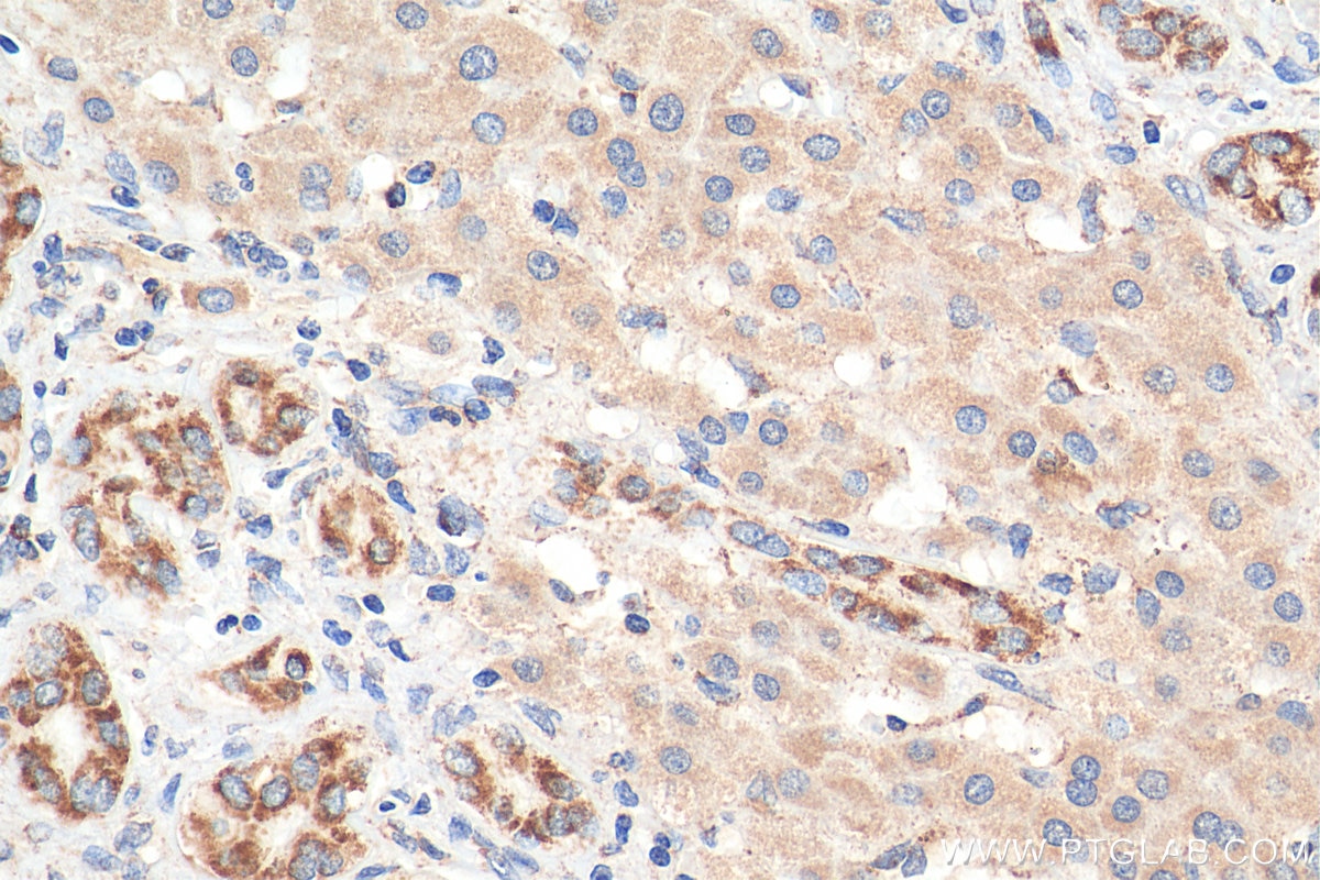 Immunohistochemistry (IHC) staining of human liver cancer tissue using C1QBP Monoclonal antibody (68084-1-Ig)