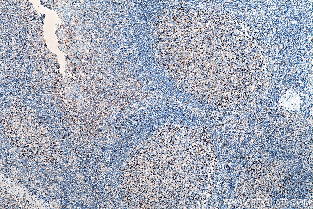 Immunohistochemistry (IHC) staining of human tonsillitis tissue using C1QBP Recombinant antibody (80490-1-RR)