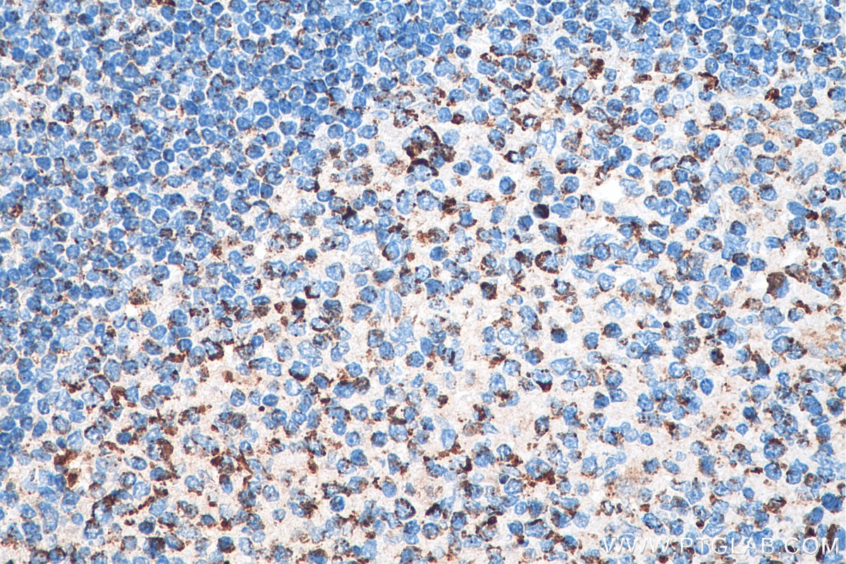 Immunohistochemistry (IHC) staining of human tonsillitis tissue using C1QBP Recombinant antibody (80490-1-RR)