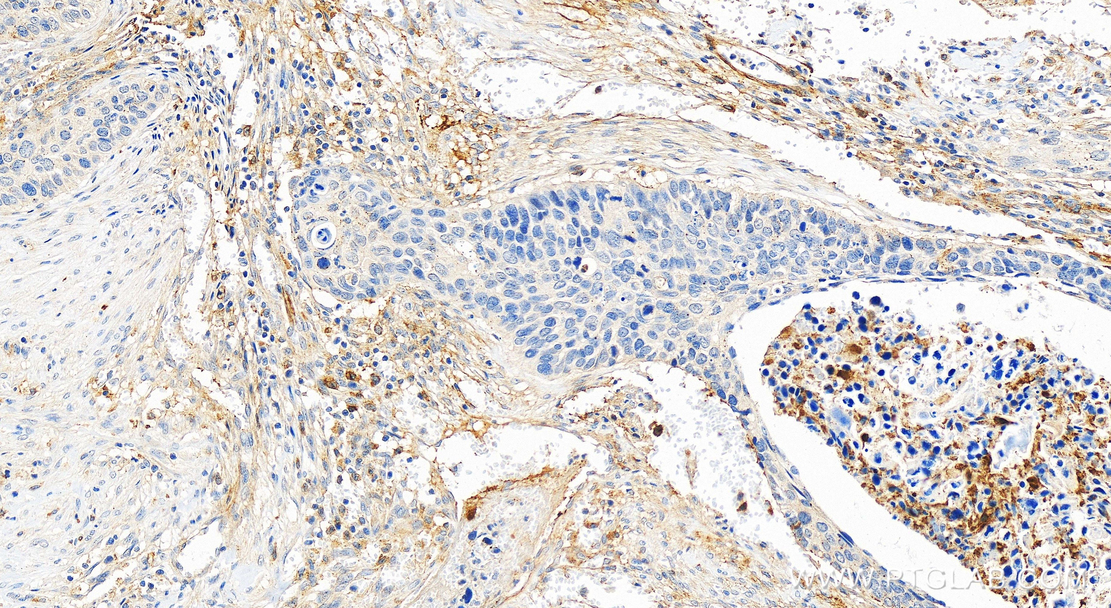 Immunohistochemistry (IHC) staining of human cervical cancer tissue using C1qC Recombinant antibody (85031-5-RR)