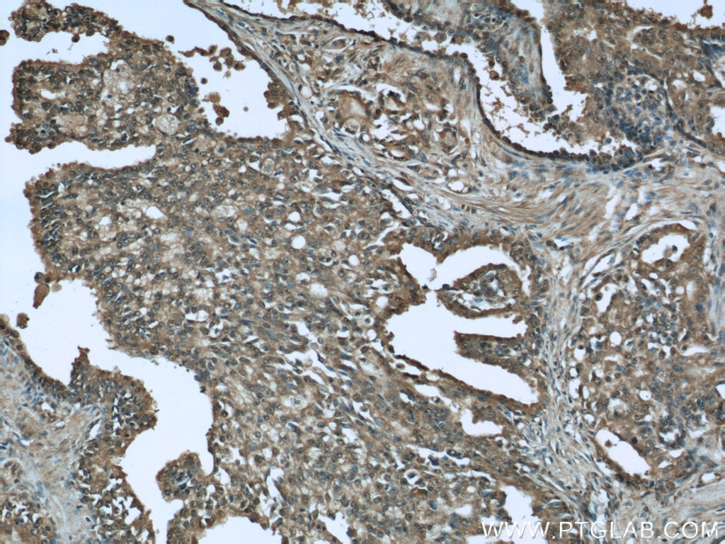 Immunohistochemistry (IHC) staining of human prostate cancer tissue using CTRP1 Polyclonal antibody (12209-1-AP)
