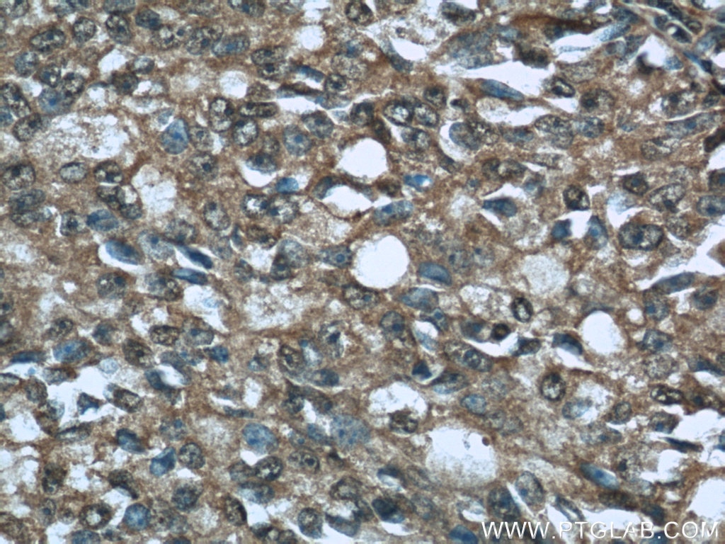 Immunohistochemistry (IHC) staining of human prostate cancer tissue using CTRP1 Polyclonal antibody (12209-1-AP)