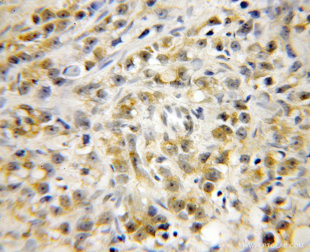 Immunohistochemistry (IHC) staining of human prostate cancer tissue using CTRP1 Polyclonal antibody (12209-1-AP)