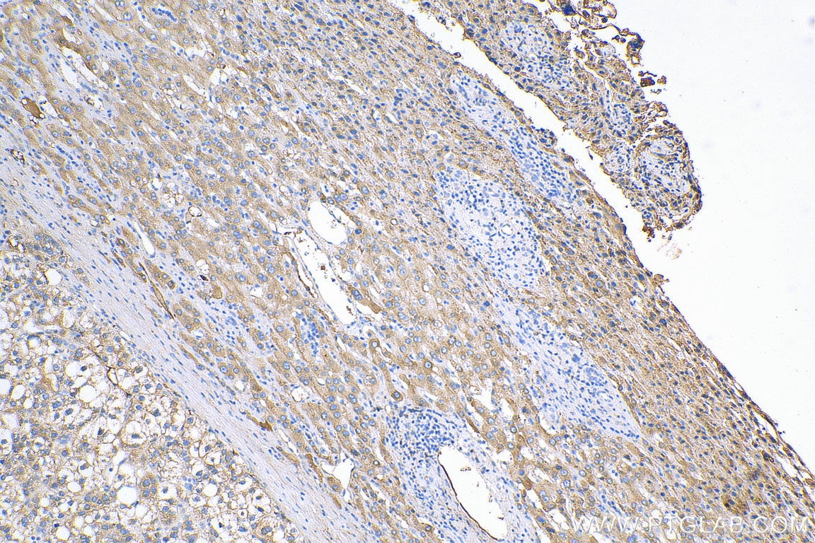 Immunohistochemistry (IHC) staining of human liver cancer tissue using C1S Polyclonal antibody (14554-1-AP)