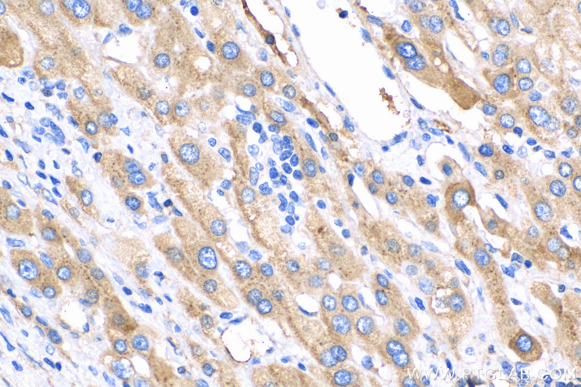 Immunohistochemistry (IHC) staining of human liver cancer tissue using C1S Polyclonal antibody (14554-1-AP)