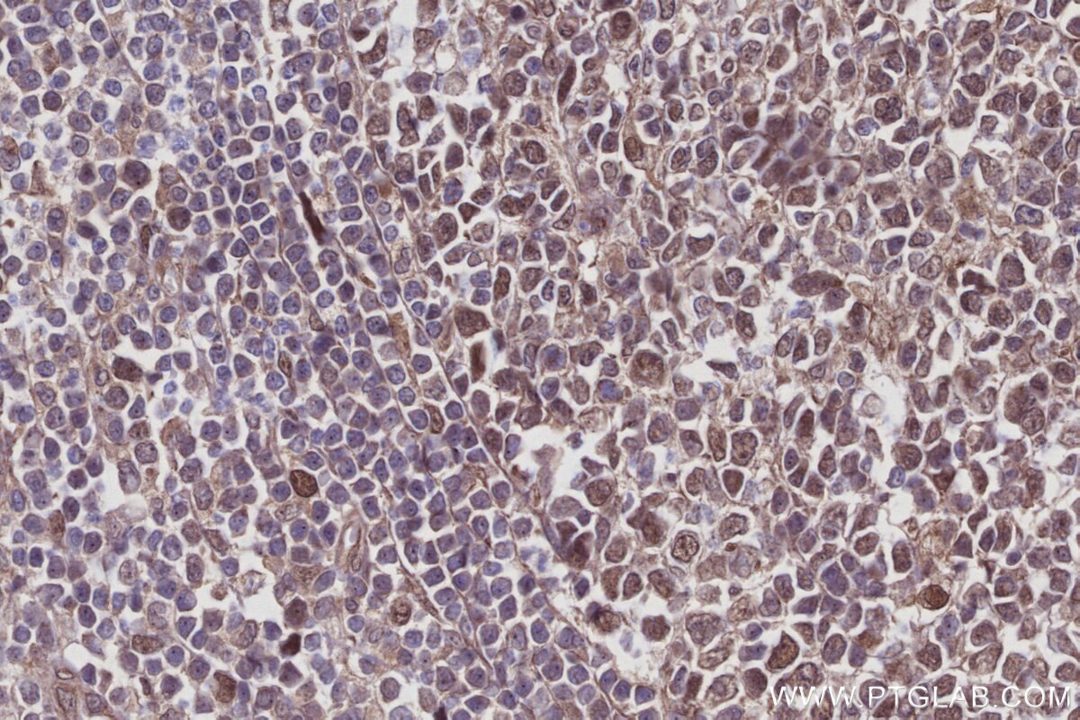 IHC staining of human appendicitis using 27863-1-AP Immunohistochemistry (IHC) staining of human appendicitis tissue using C1orf112 Polyclonal antibody (27863-1-AP)