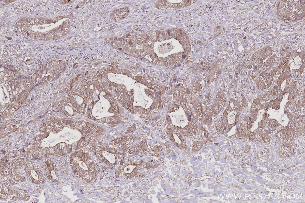 IHC staining of human pancreas cancer using 27863-1-AP Immunohistochemistry (IHC) staining of human pancreas cancer tissue using C1orf112 Polyclonal antibody (27863-1-AP)