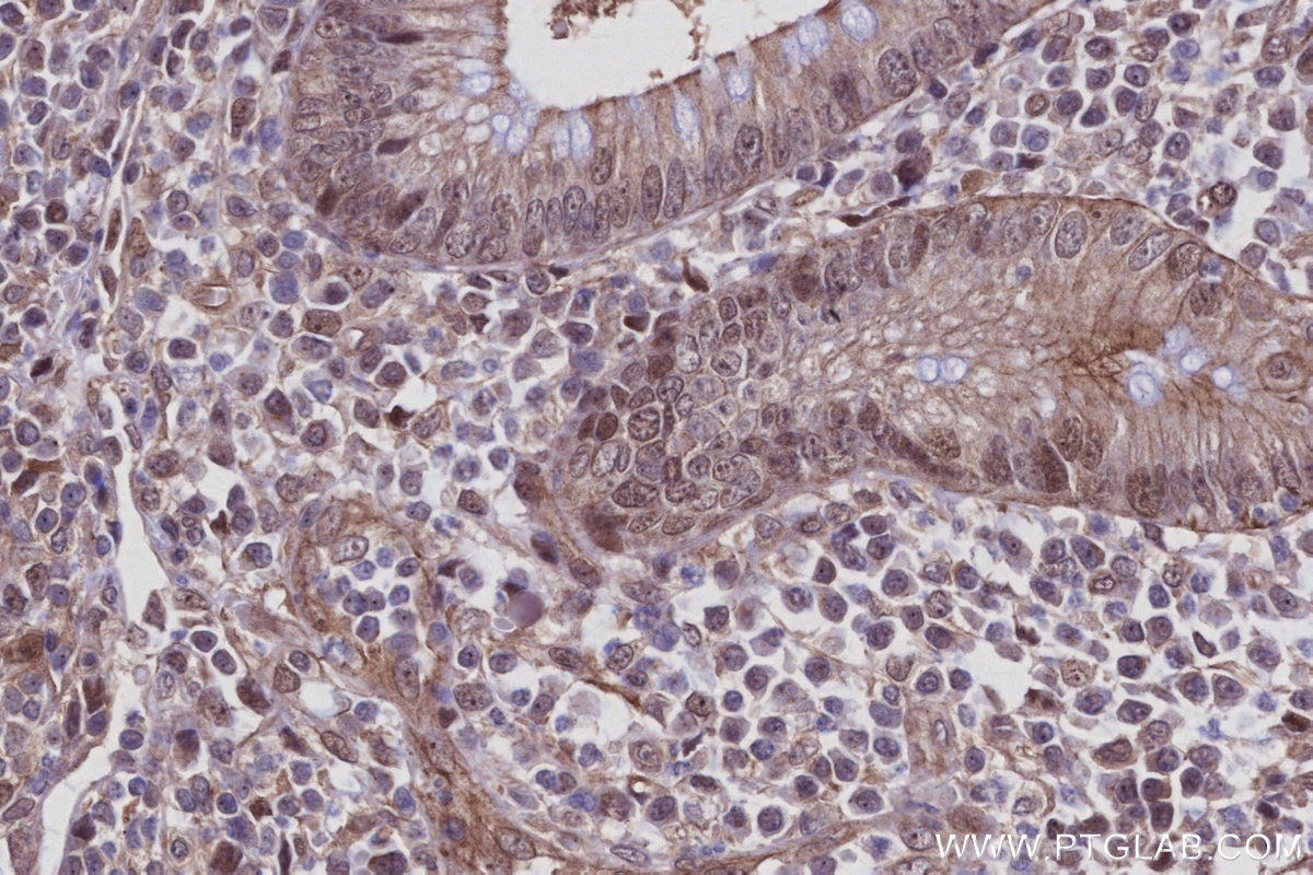 IHC staining of human appendicitis using 27863-1-AP Immunohistochemistry (IHC) staining of human appendicitis tissue using C1orf112 Polyclonal antibody (27863-1-AP)