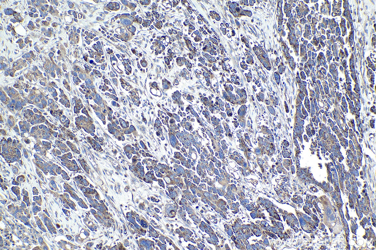 Immunohistochemistry (IHC) staining of human colon cancer tissue using COA7 Polyclonal antibody (25361-1-AP)