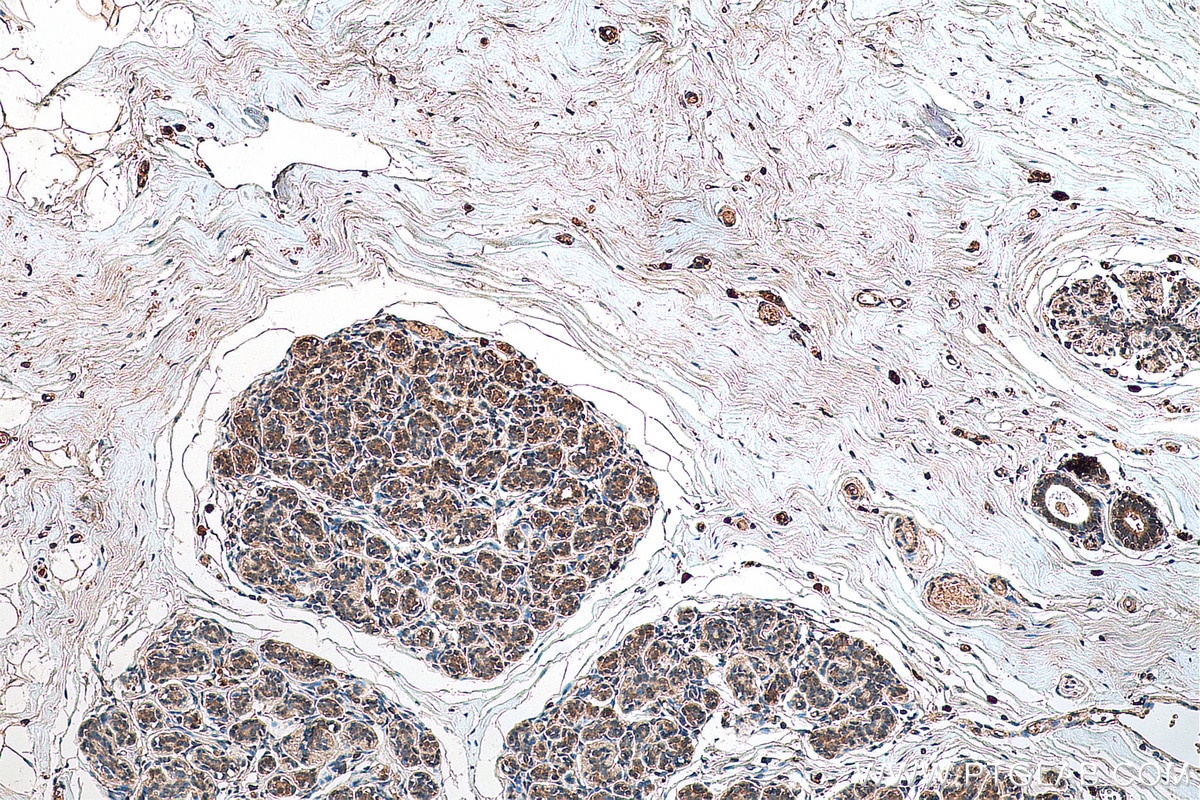 Immunohistochemistry (IHC) staining of human breast cancer tissue using C1orf27 Polyclonal antibody (22844-1-AP)