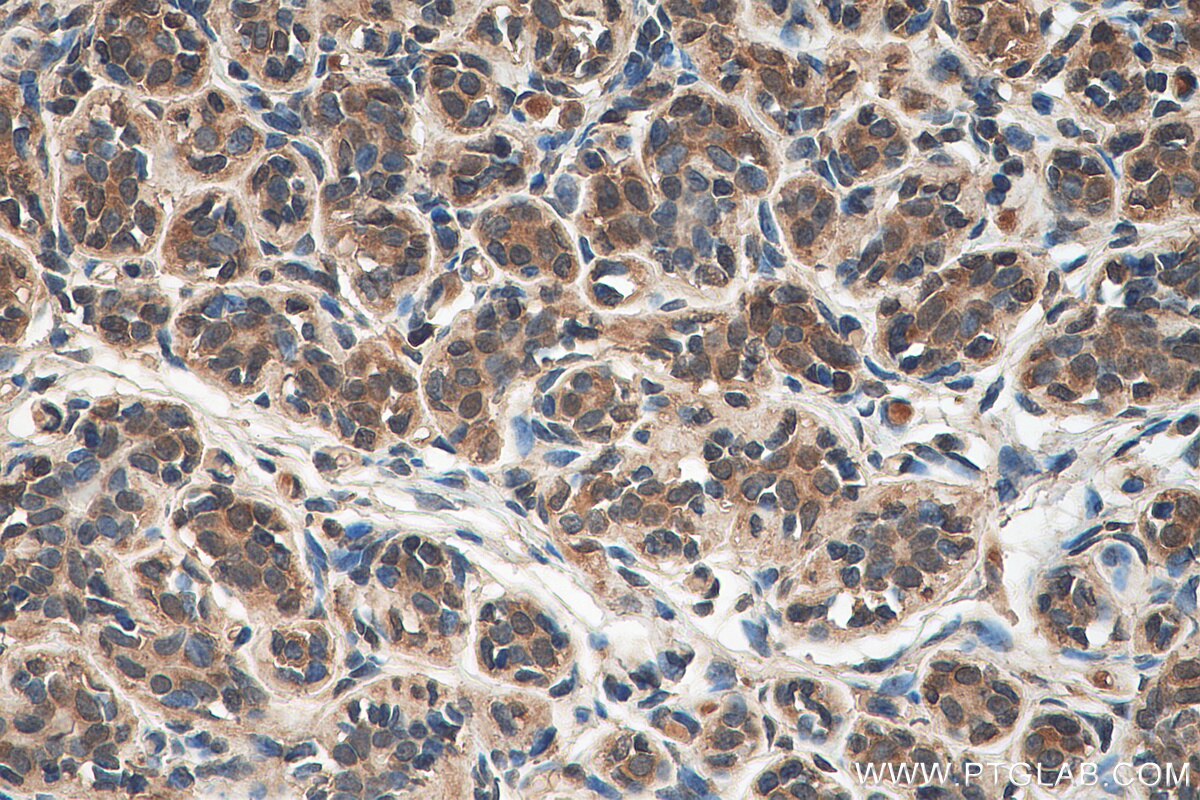 Immunohistochemistry (IHC) staining of human breast cancer tissue using C1orf27 Polyclonal antibody (22844-1-AP)