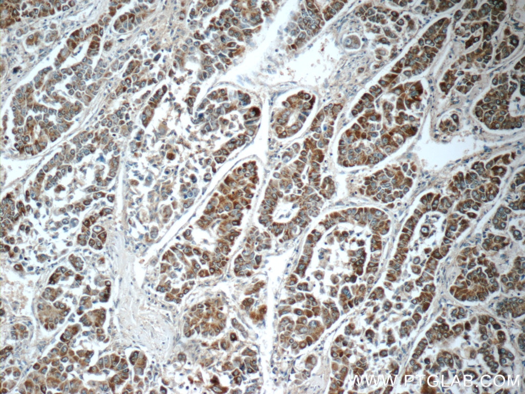 Immunohistochemistry (IHC) staining of human liver cancer tissue using C1orf56 Polyclonal antibody (25433-1-AP)