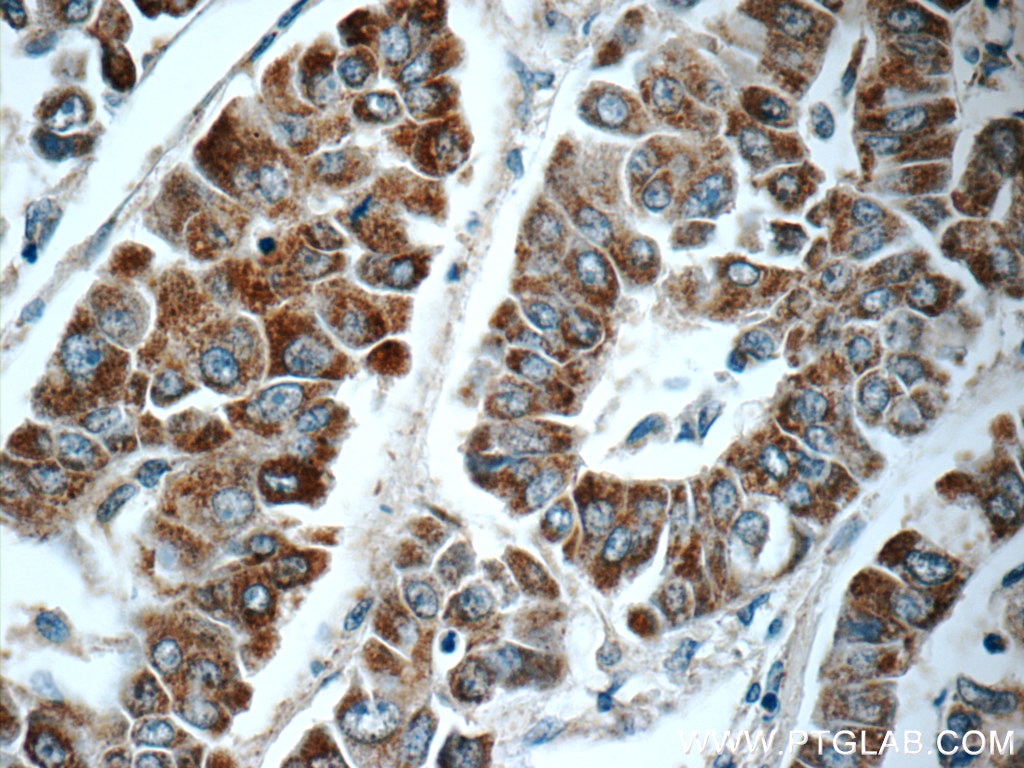 Immunohistochemistry (IHC) staining of human liver cancer tissue using C1orf56 Polyclonal antibody (25433-1-AP)