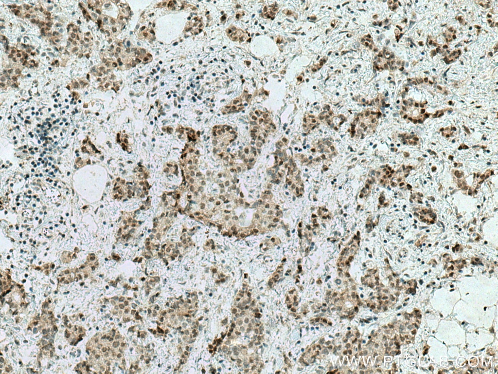 Immunohistochemistry (IHC) staining of human breast cancer tissue using C1orf58 Polyclonal antibody (26109-1-AP)