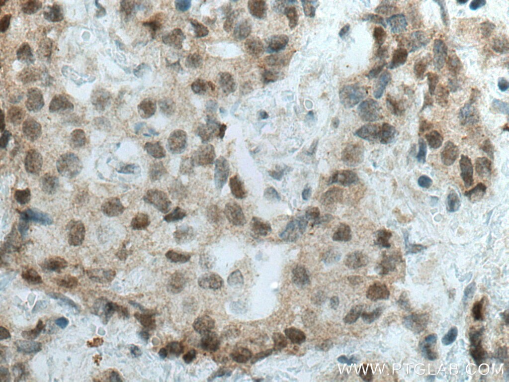 Immunohistochemistry (IHC) staining of human breast cancer tissue using C1orf58 Polyclonal antibody (26109-1-AP)