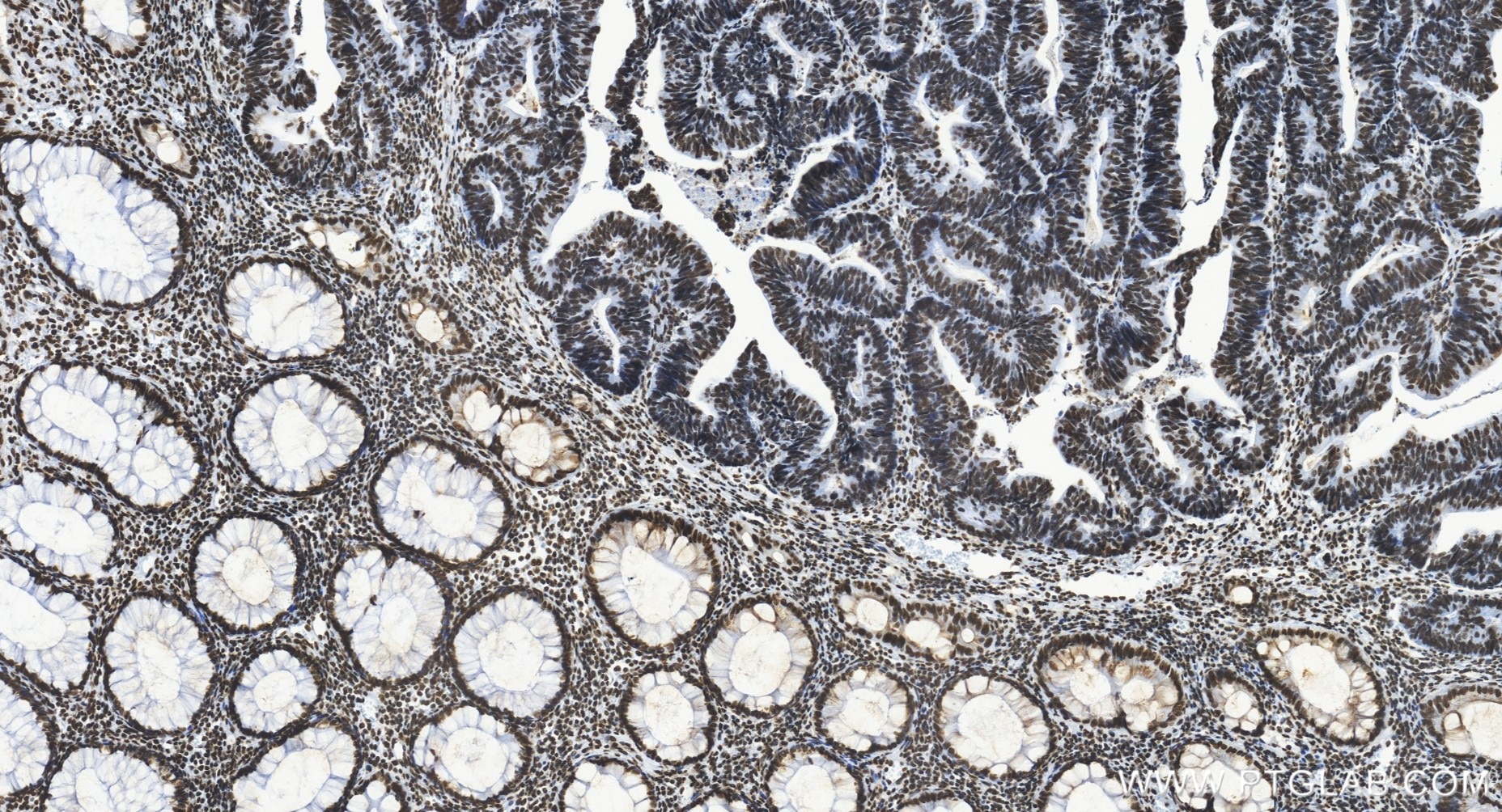 Immunohistochemistry (IHC) staining of human colon cancer tissue using C1orf77 Recombinant monoclonal antibody (85147-3-RR)