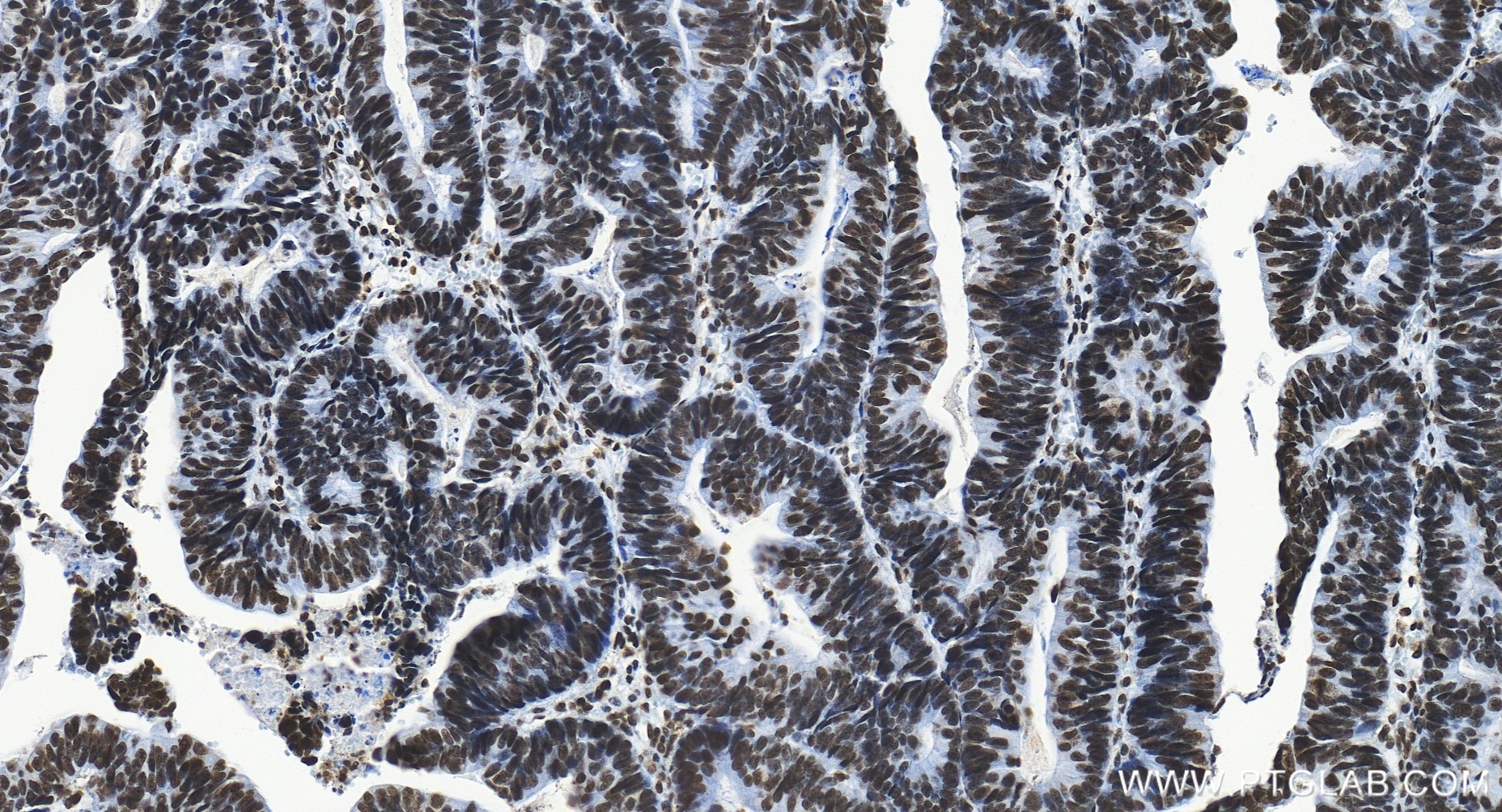 Immunohistochemistry (IHC) staining of human colon cancer tissue using C1orf77 Recombinant monoclonal antibody (85147-3-RR)