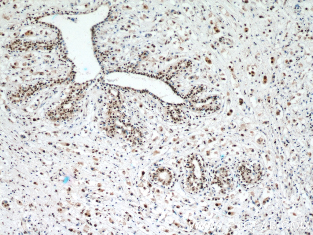 IHC staining of human breast cancer using 20940-1-AP
