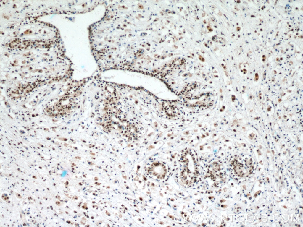 Immunohistochemistry (IHC) staining of human breast cancer tissue using C1orf83 Polyclonal antibody (20940-1-AP)