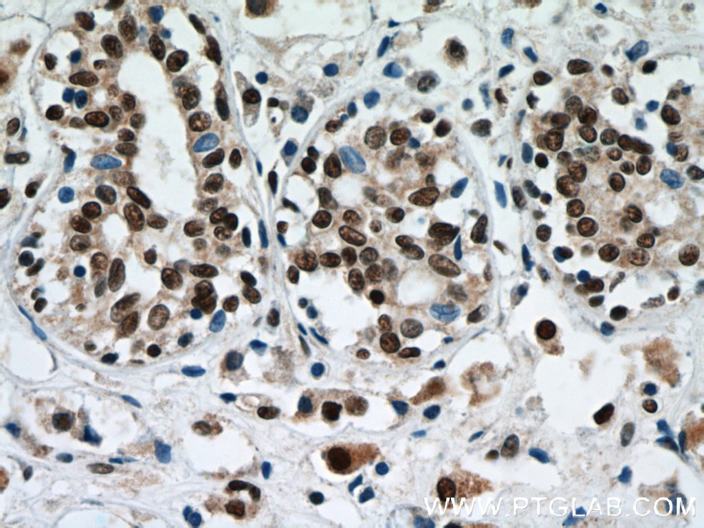 Immunohistochemistry (IHC) staining of human breast cancer tissue using C1orf83 Polyclonal antibody (20940-1-AP)