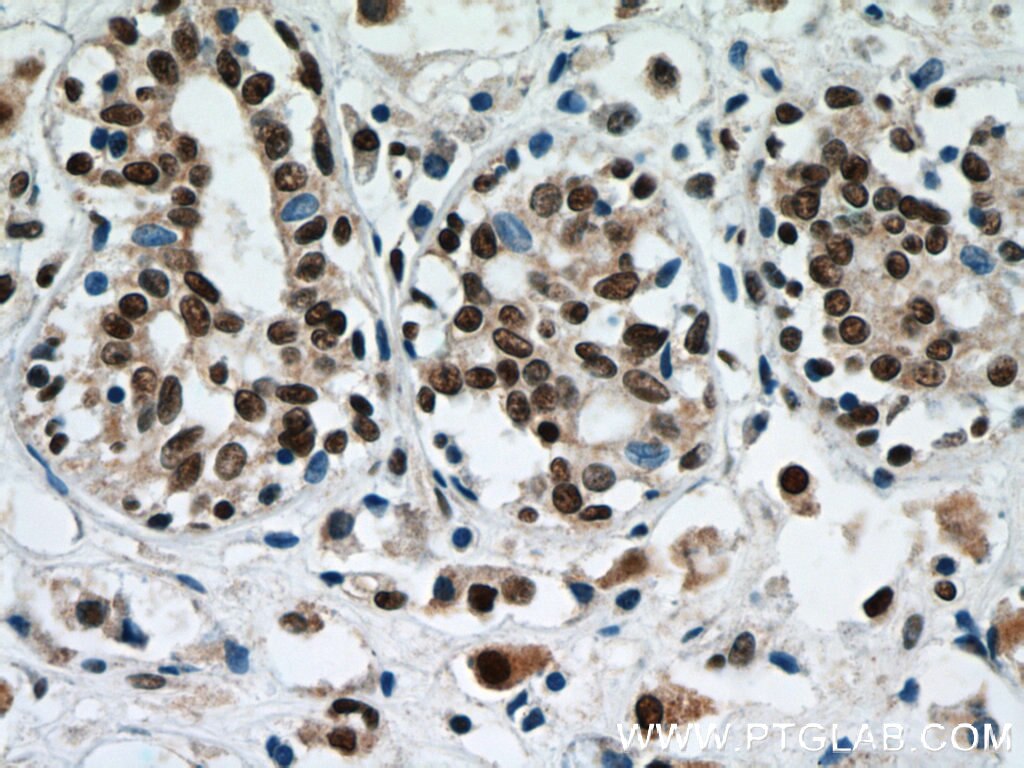 IHC staining of human breast cancer using 20940-1-AP