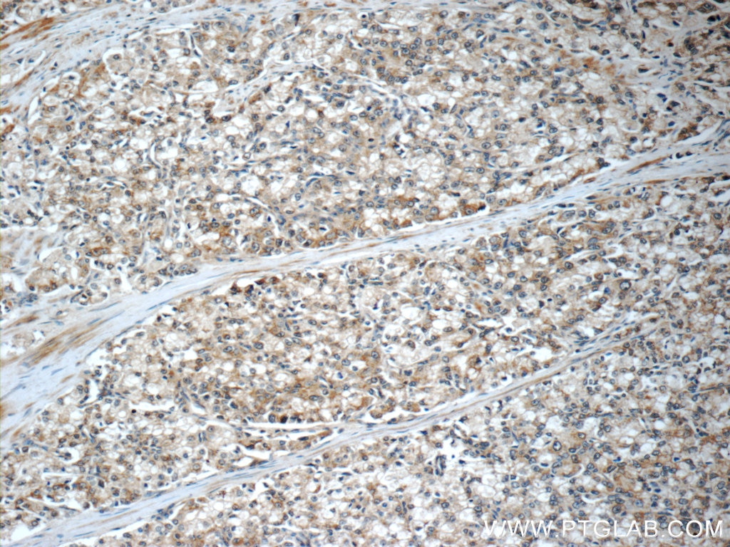Immunohistochemistry (IHC) staining of human prostate cancer tissue using C20orf195 Polyclonal antibody (16040-1-AP)
