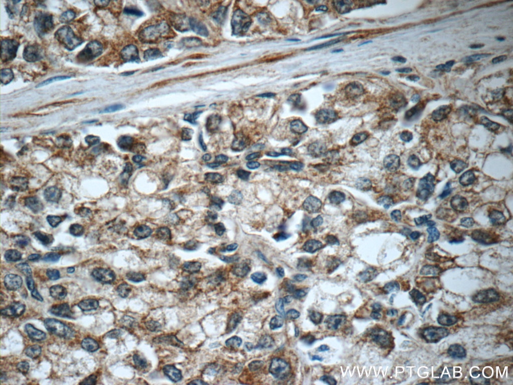 Immunohistochemistry (IHC) staining of human prostate cancer tissue using C20orf195 Polyclonal antibody (16040-1-AP)