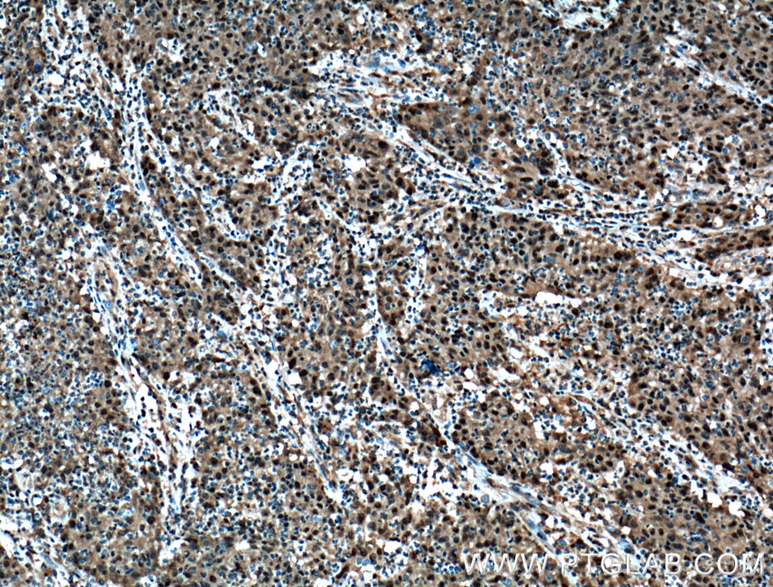 IHC staining of human colon cancer using 26040-1-AP