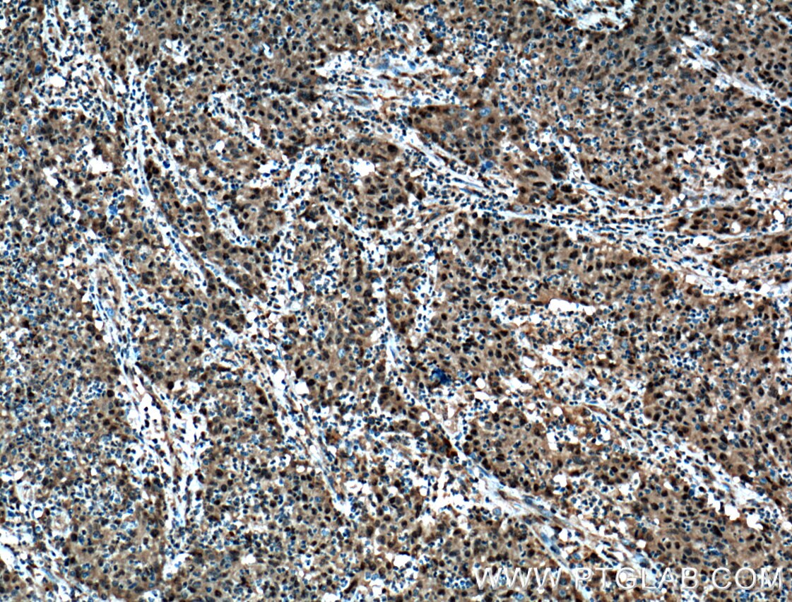 Immunohistochemistry (IHC) staining of human colon cancer tissue using C20orf20 Polyclonal antibody (26040-1-AP)